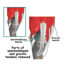 tendons,semitendinosis muscle,acl injury,acl reconstruction india,acl reconstruction best india,acl reconstructionbest doctors in india,acl reconstruction best surgeon in india,acl reconstructionbest surgery in india,acl reconstruction best treatment in  india,acl reconstruction in south  india,acl reconstruction north  india,acl reconstruction  east india,acl reconstruction west india,acl reconstruction best in  india,acl reconstruction best surgery in india,acl reconstruction cost-effective in  india,acl reconstruction best doctors in india,acl reconstruction india,acl reconstruction india,acl reconstruction india,acl reconstruction now in india,acl reconstruction india,acl reconstruction by dr.bajaj,acl reconstruction by p.s.bajaj